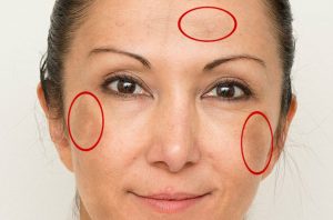 Cilt Lekesine Kesin Çözüm