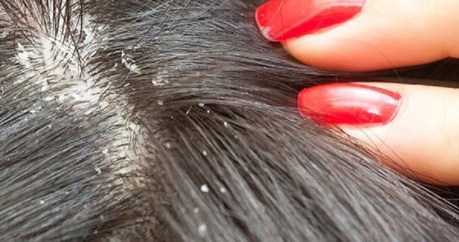 Kepek Nasıl Önlenir?