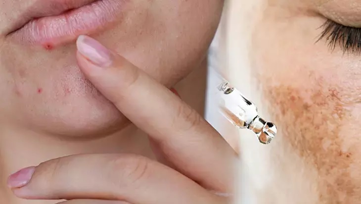 Güneş ve Cilt Lekelerinden 2 Doğal Malzeme ile Kurtulun! Etkili Ev Yapımı Karışım