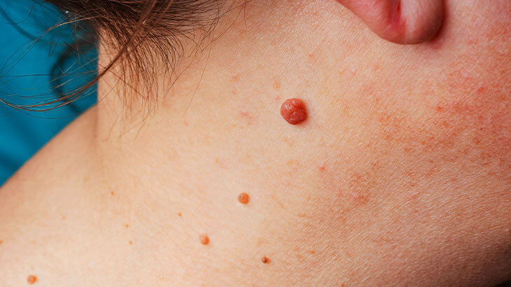 Et Benlerini Azaltmaya Yardımcı Doğal Yöntem! Evdeki Tek Bir Malzeme Bile Yetiyor