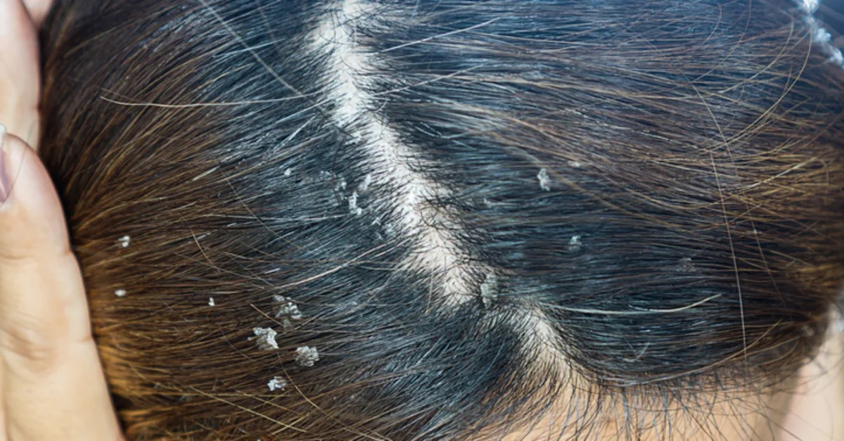 Saç Diplerindeki Egzamaya Doğal Çözüm! 40 Dakika Bekletmeniz Yeterli: Saçı Parlatıyor, Yumuşatıyor