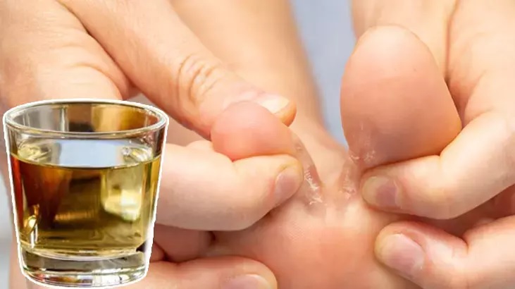 Ayak Mantarına Doğal Çözüm! Her Evde Bulunan Bu Malzeme 15 Dakikada Etki Ediyor